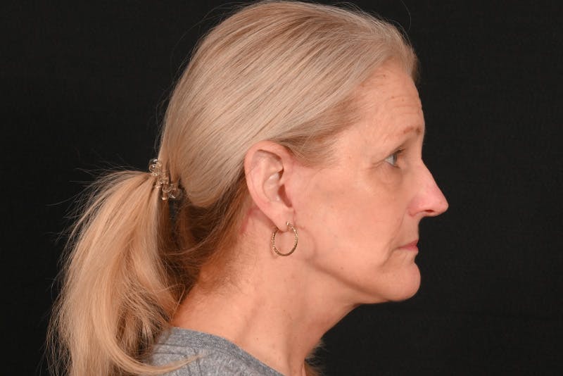 Facelift Before & After Gallery - Patient 762765 - Image 2