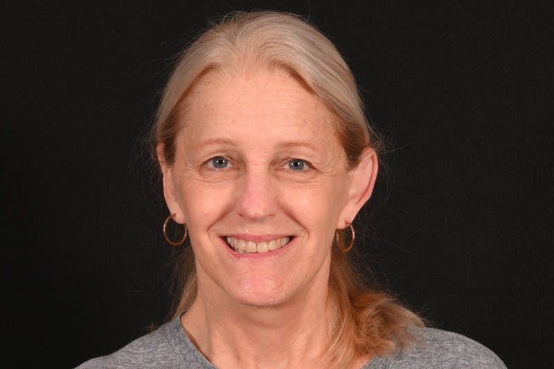 Facelift Before & After Gallery - Patient 762765 - Image 8