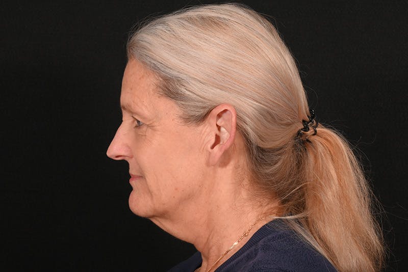 Facelift Before & After Gallery - Patient 762765 - Image 15