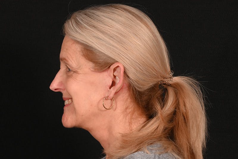 Facelift Before & After Gallery - Patient 762765 - Image 18