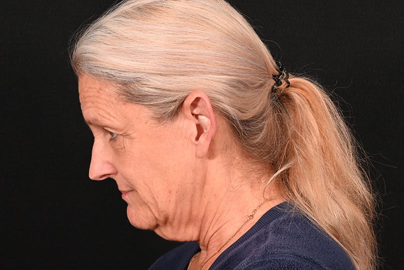 Facelift Before & After Gallery - Patient 762765 - Image 19