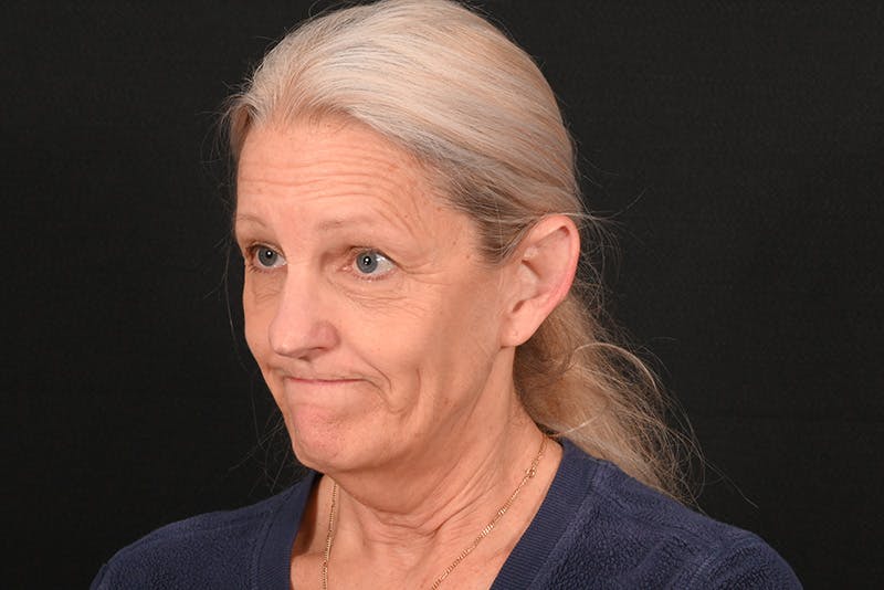 Facelift Before & After Gallery - Patient 762765 - Image 13