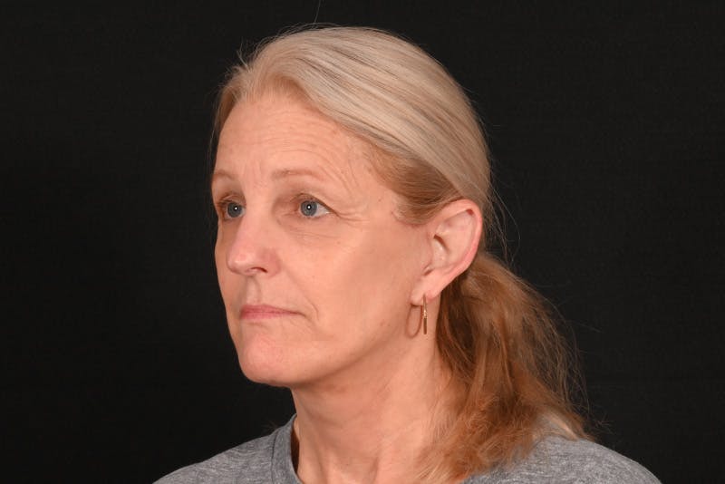 Facelift Before & After Gallery - Patient 762765 - Image 14