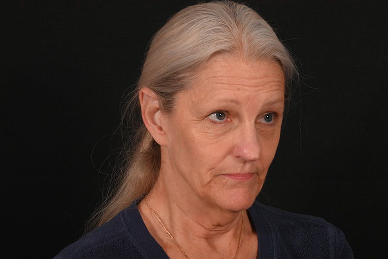 Facelift Before & After Gallery - Patient 762765 - Image 3