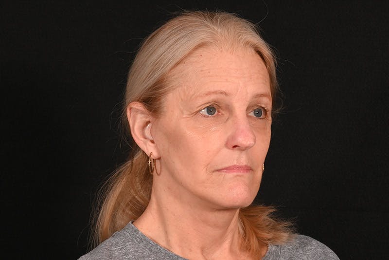 Facelift Before & After Gallery - Patient 762765 - Image 4