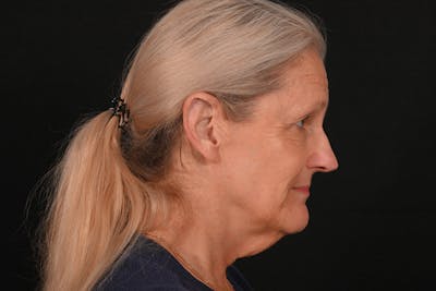 Facelift Before & After Gallery - Patient 762765 - Image 1