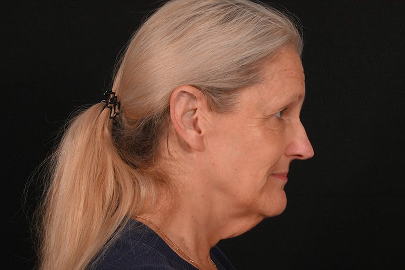 Facelift Before & After Gallery - Patient 762765 - Image 1