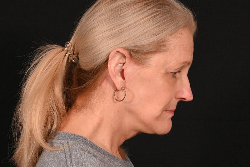 Facelift Before & After Gallery - Patient 762765 - Image 12