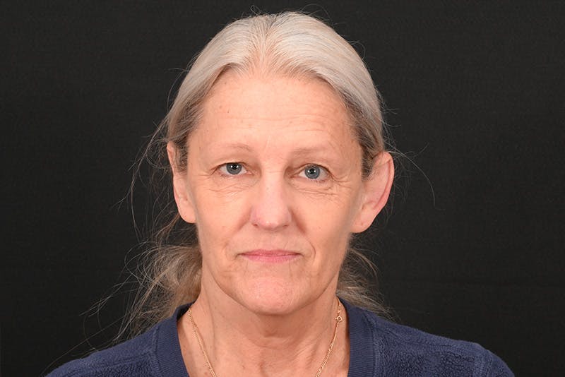 Facelift Before & After Gallery - Patient 762765 - Image 5