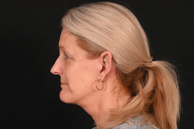 Facelift Before & After Gallery - Patient 762765 - Image 16