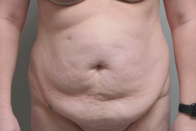 Abdominoplasty Before & After Gallery - Patient 245440 - Image 1