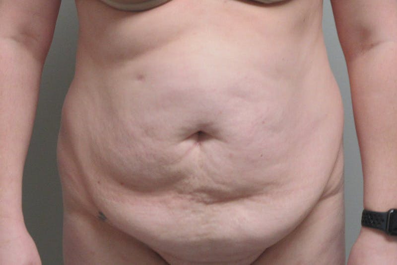 Abdominoplasty Before & After Gallery - Patient 245440 - Image 1