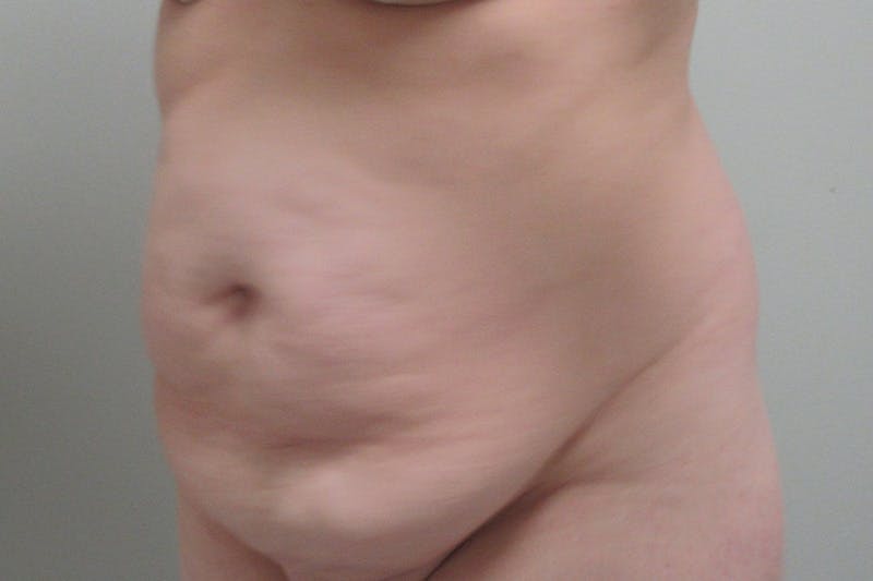 Abdominoplasty Before & After Gallery - Patient 245440 - Image 3