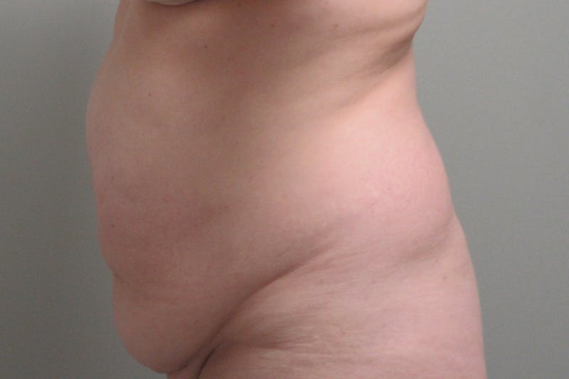 Abdominoplasty Before & After Gallery - Patient 245440 - Image 5