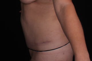 Abdominoplasty Before & After Gallery - Patient 245440 - Image 6