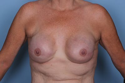 Breast Reconstruction Revision Before & After Gallery - Patient 300804 - Image 2