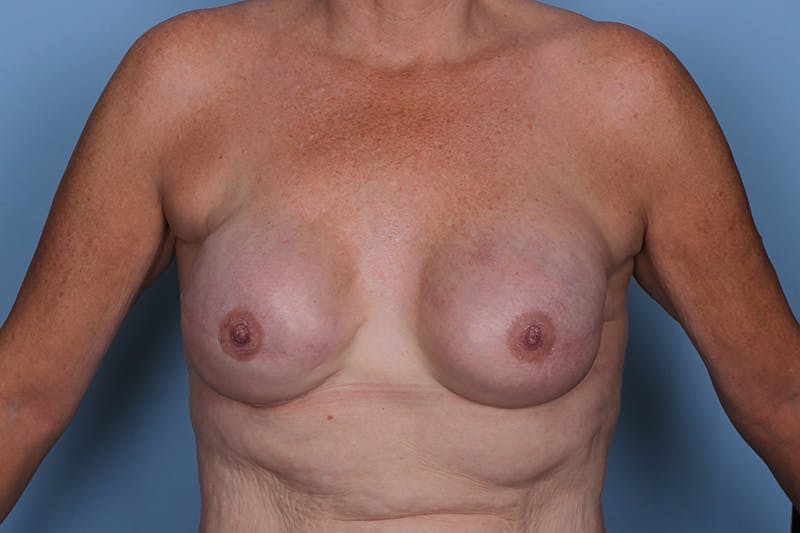 Breast Reconstruction Revision Before & After Gallery - Patient 300804 - Image 2