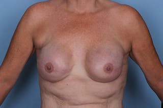 Breast Reconstruction Revision Before & After Gallery - Patient 300804 - Image 2