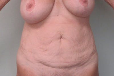 Abdominoplasty Before & After Gallery - Patient 335044 - Image 1