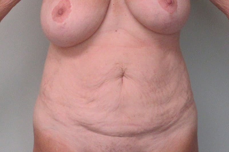 Abdominoplasty Before & After Gallery - Patient 335044 - Image 1