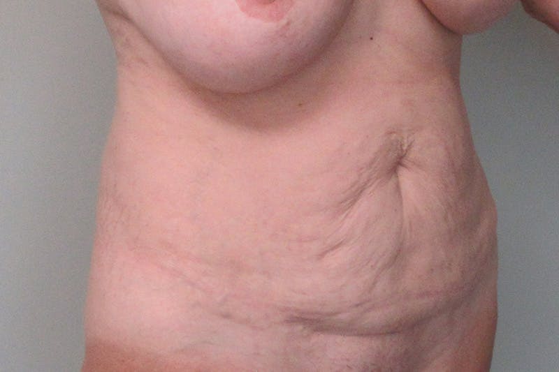 Abdominoplasty Before & After Gallery - Patient 335044 - Image 3