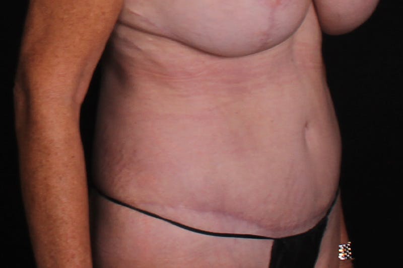 Abdominoplasty Before & After Gallery - Patient 335044 - Image 4