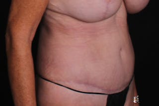 Abdominoplasty Before & After Gallery - Patient 335044 - Image 4
