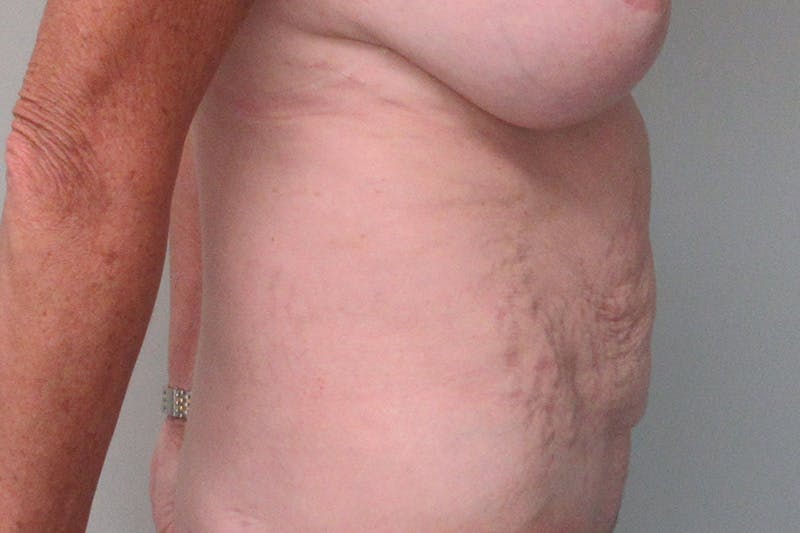 Abdominoplasty Before & After Gallery - Patient 335044 - Image 5