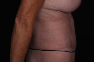 Abdominoplasty Before & After Gallery - Patient 335044 - Image 6