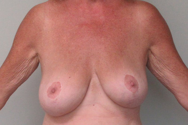 Breast Augmentation with Lift Before & After Gallery - Patient 359092 - Image 1