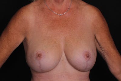 Breast Augmentation with Lift Before & After Gallery - Patient 359092 - Image 2