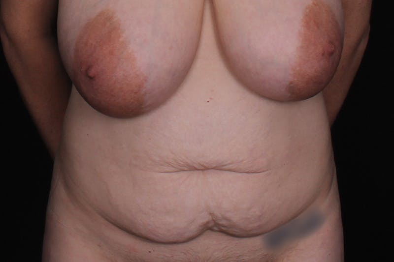 Abdominoplasty Before & After Gallery - Patient 249387 - Image 1