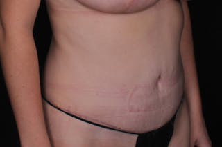 Abdominoplasty Before & After Gallery - Patient 249387 - Image 6