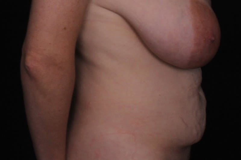 Abdominoplasty Before & After Gallery - Patient 249387 - Image 5