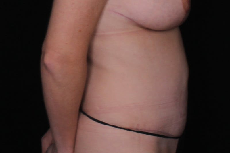 Abdominoplasty Before & After Gallery - Patient 249387 - Image 4