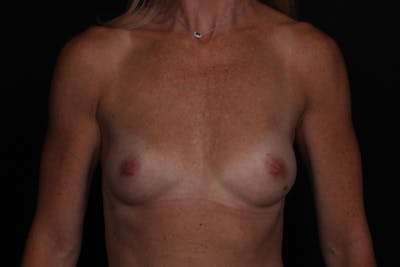 Breast Augmentation Before & After Gallery - Patient 303307 - Image 1