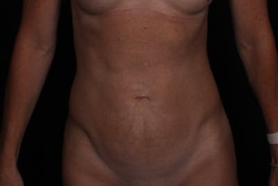 Abdominoplasty Before & After Gallery - Patient 268545 - Image 1