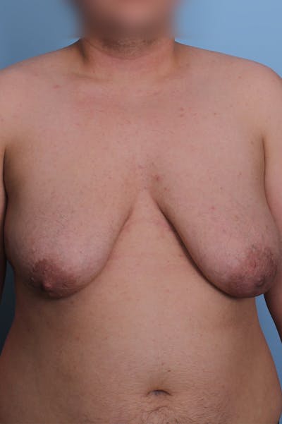 FTM Top Surgery Before & After Gallery - Patient 348384 - Image 1