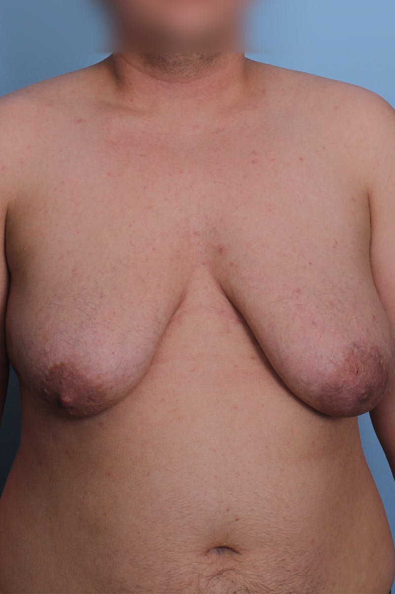 FTM Top Surgery Before & After Gallery - Patient 348384 - Image 1