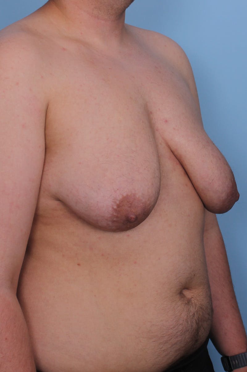 FTM Top Surgery Before & After Gallery - Patient 348384 - Image 3