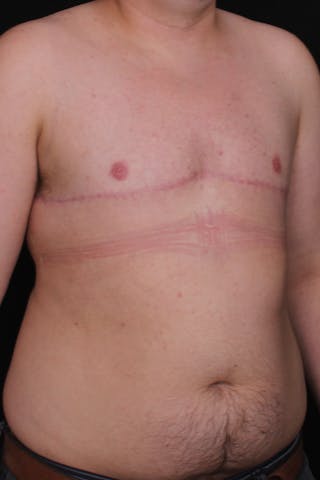 FTM Top Surgery Before & After Gallery - Patient 348384 - Image 4