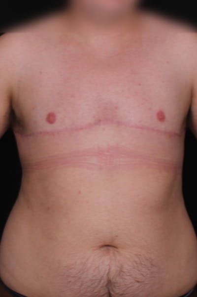 FTM Top Surgery Before & After Gallery - Patient 348384 - Image 2