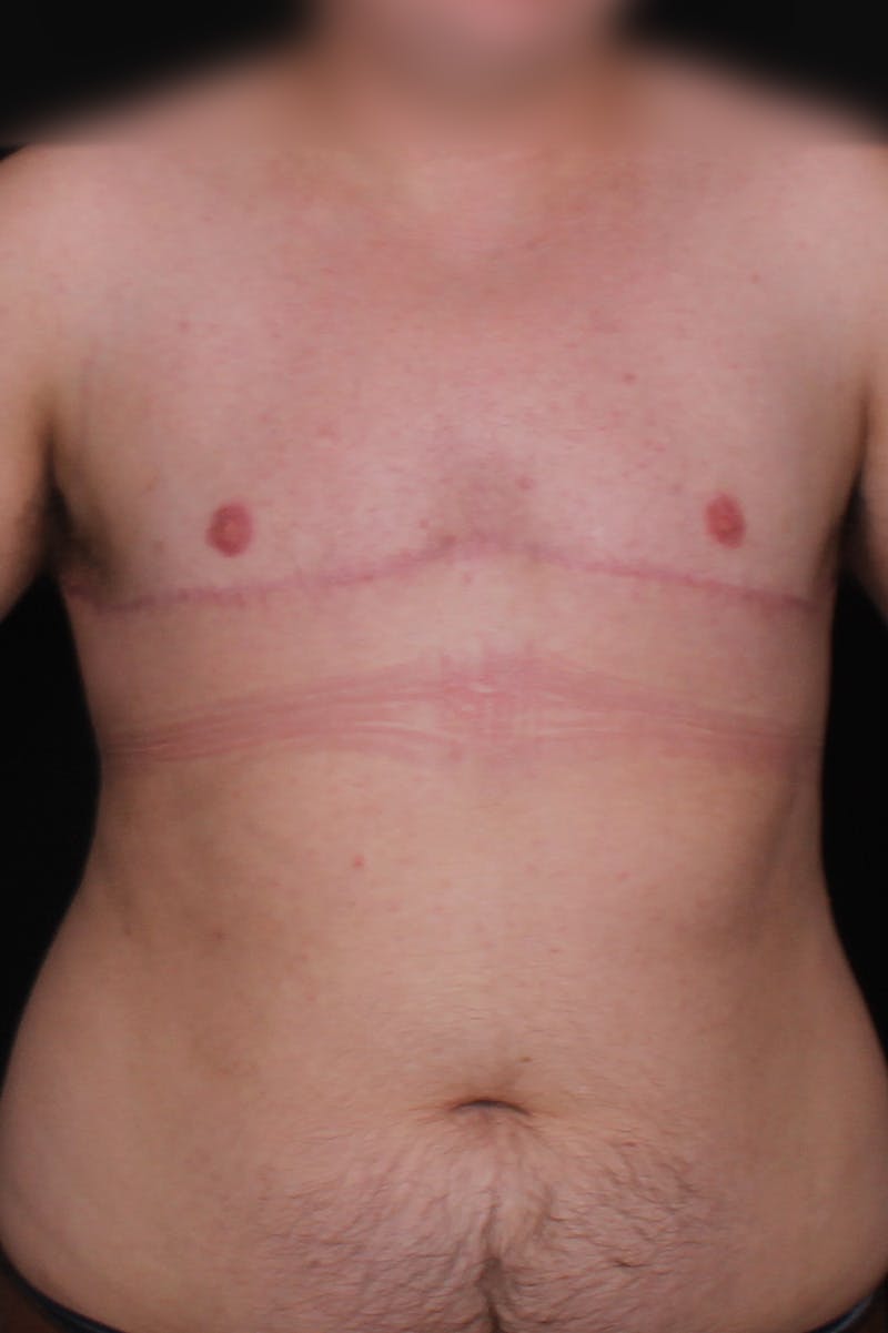 FTM Top Surgery Before & After Gallery - Patient 348384 - Image 2