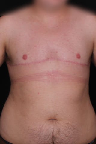 FTM Top Surgery Before & After Gallery - Patient 348384 - Image 2
