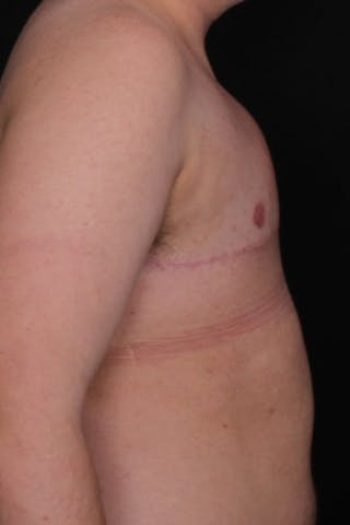 FTM Top Surgery Before & After Gallery - Patient 348384 - Image 6