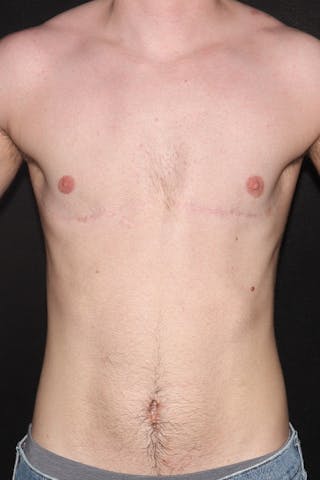 FTM Top Surgery Before & After Gallery - Patient 650595 - Image 2