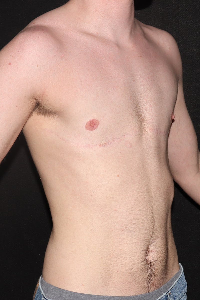 FTM Top Surgery Before & After Gallery - Patient 650595 - Image 4