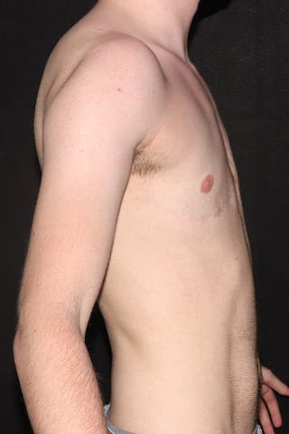 FTM Top Surgery Before & After Gallery - Patient 650595 - Image 6