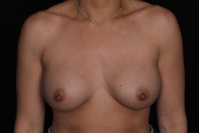 Breast Explant Before & After Gallery - Patient 918589 - Image 1