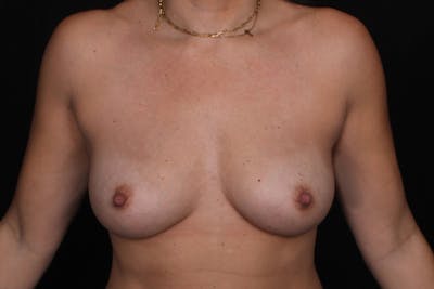 Breast Explant Before & After Gallery - Patient 918589 - Image 2